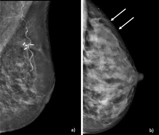 digital mammography reader fuji FCR XL-2